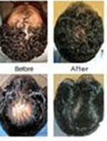 درمان قطع ریزش مو- شامپو ضد ریزش مو جنسینگ (فوق العاده قوی)