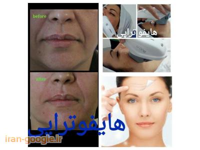 جراحی زیبایی صورت-مرکز زیبایی و لیزر در ستاری ، پیوند موی طبیعی به روش FIT و FUT 
