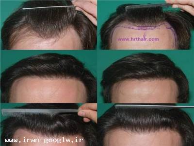 کاشت موی طبیعی-کلینیک فوق تخصصی کاشت مو وترمیم موی رنسانس 
