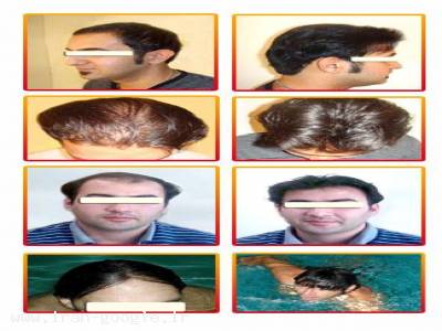کاشت موی طبیعی-قیمت کاشت موی طبیعی|مرکز تخصصی موی رنسانس