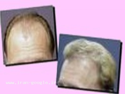 کاشت موی طبیعی-مرکز تخصصی کاشت موی طبیعی و قابل FIT کرمان