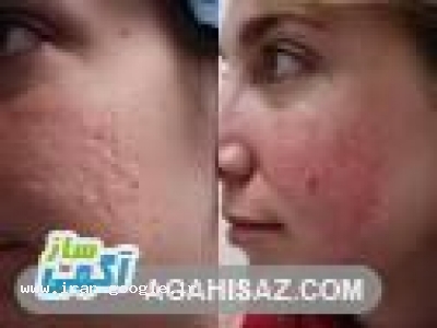 درمان لک و جوش های صورت-پزشک پوست وزیبایی در تهران