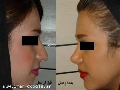 جراحی زیبایی صورت- جراح پلاستیک بینی درخوزستان ،جراحی بینی بدون درد  