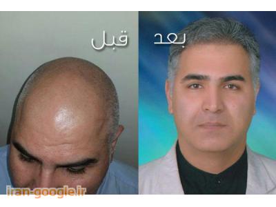 کاشت موی طبیعی-دکتر علی فولادیان مرکز کاشت موی طبیعی در تهران 
